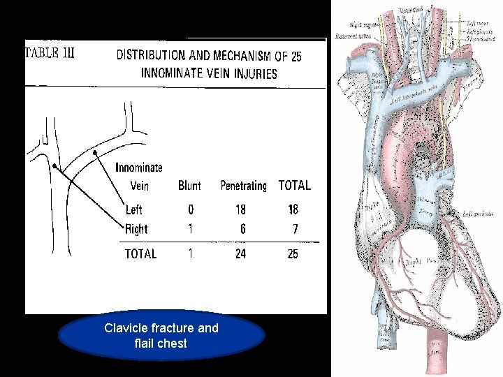 Clavicle fracture and flail chest Clavicle fracture and flail chest