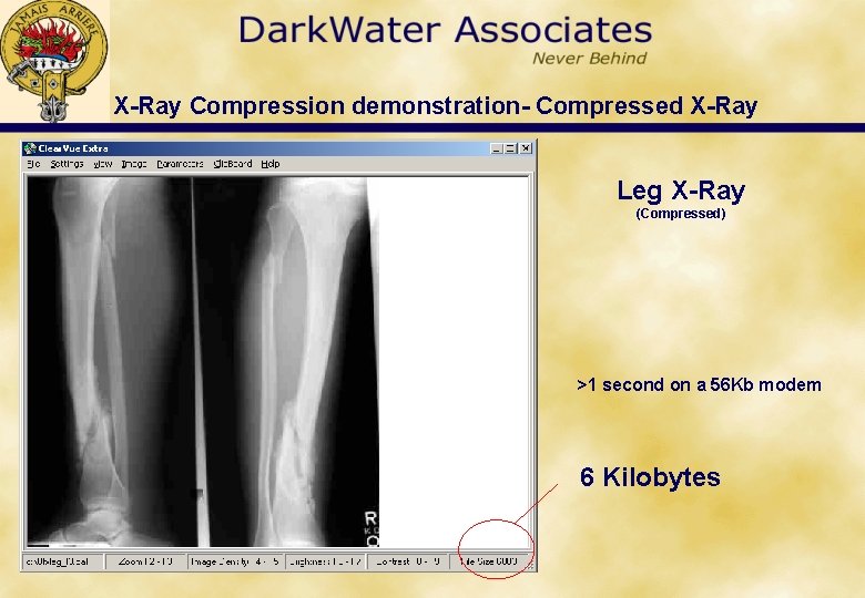 X-Ray Compression demonstration- Compressed X-Ray Leg X-Ray (Compressed) >1 second on a 56 Kb