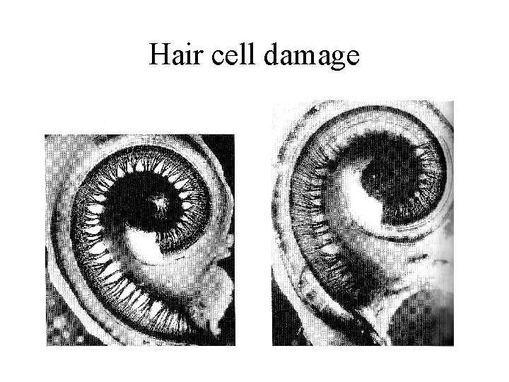 Hair cell damage 