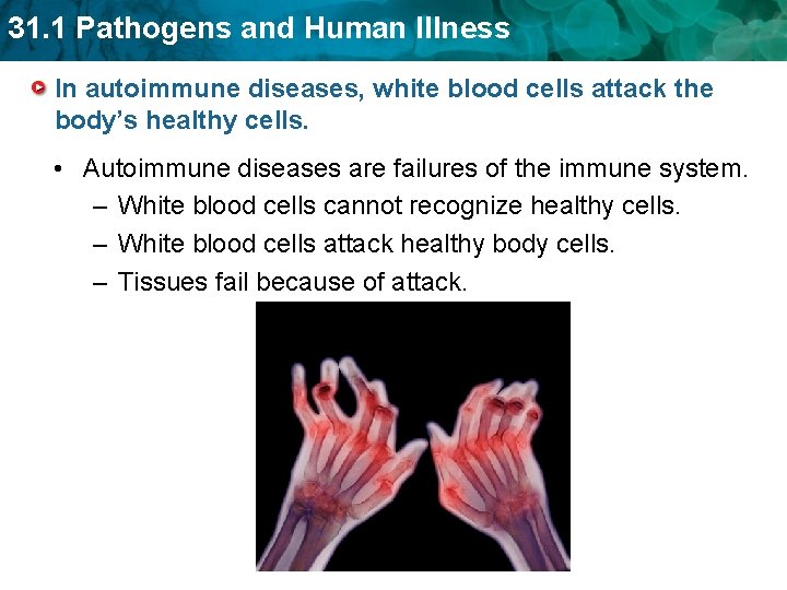 31. 1 Pathogens and Human Illness In autoimmune diseases, white blood cells attack the