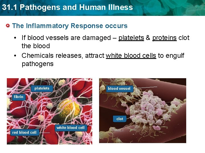 31. 1 Pathogens and Human Illness The Inflammatory Response occurs • If blood vessels