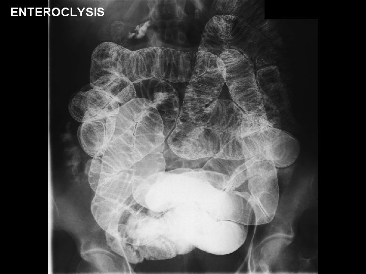 ENTEROCLYSIS 