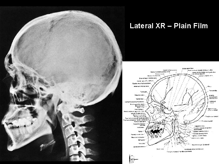 Lateral XR – Plain Film 