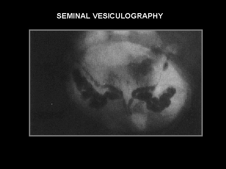 SEMINAL VESICULOGRAPHY 