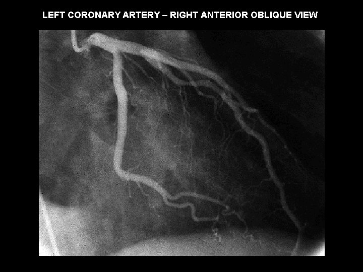 LEFT CORONARY ARTERY – RIGHT ANTERIOR OBLIQUE VIEW 