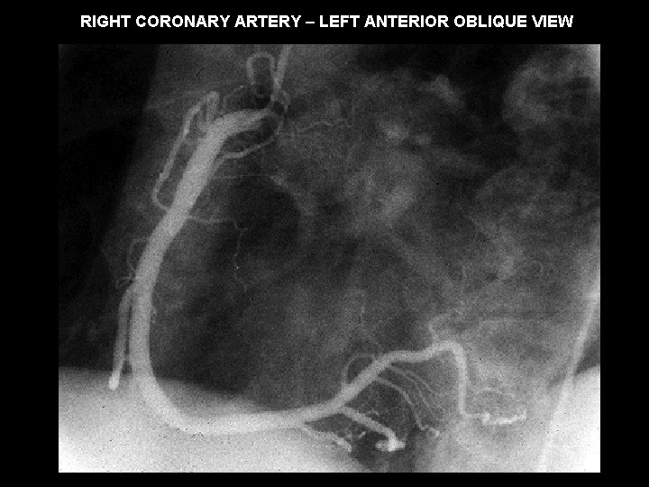 RIGHT CORONARY ARTERY – LEFT ANTERIOR OBLIQUE VIEW 