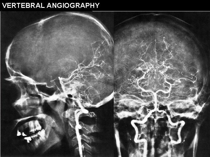 VERTEBRAL ANGIOGRAPHY 