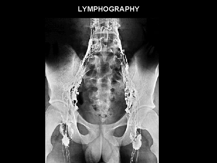 LYMPHOGRAPHY 