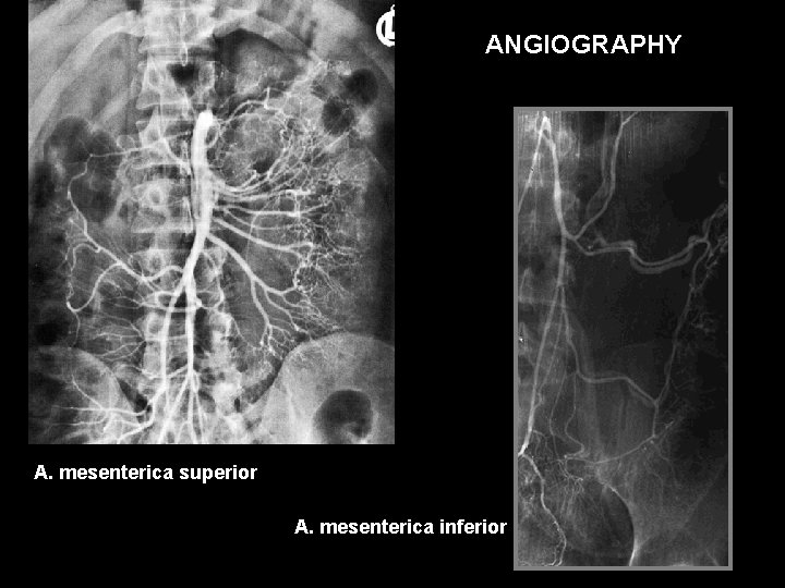 ANGIOGRAPHY A. mesenterica superior A. mesenterica inferior 