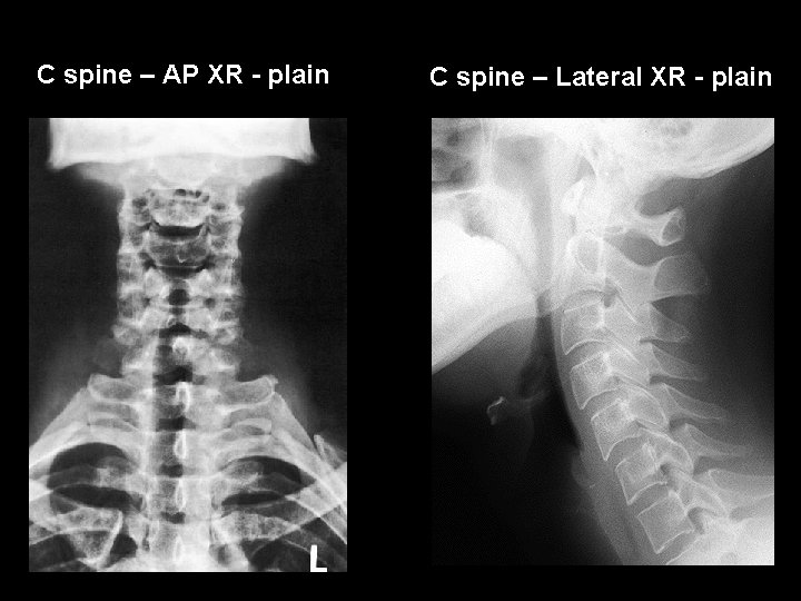 C spine – AP XR - plain C spine – Lateral XR - plain