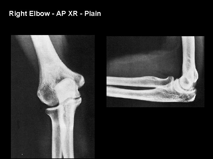 Right Elbow - AP XR - Plain 