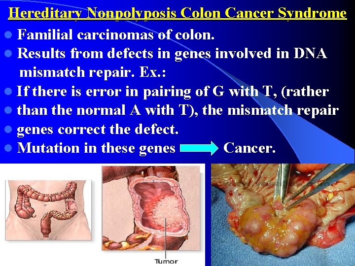 Hereditary Nonpolyposis Colon Cancer Syndrome l Familial carcinomas of colon. l Results from defects