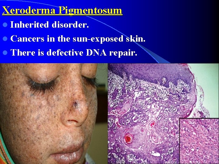 Xeroderma Pigmentosum l Inherited disorder. l Cancers in the sun-exposed skin. l There is