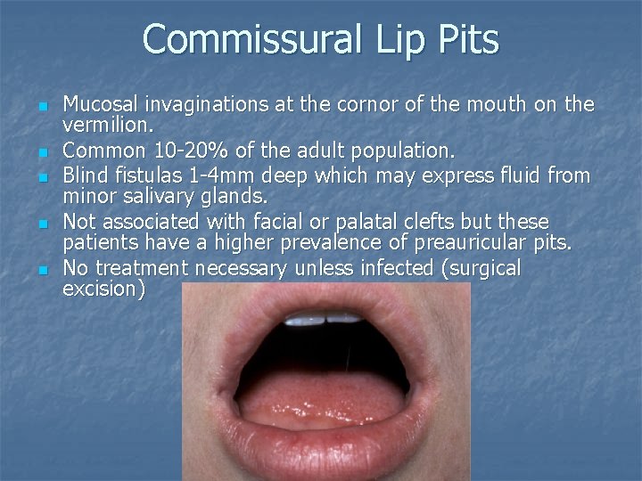 Commissural Lip Pits n n n Mucosal invaginations at the cornor of the mouth