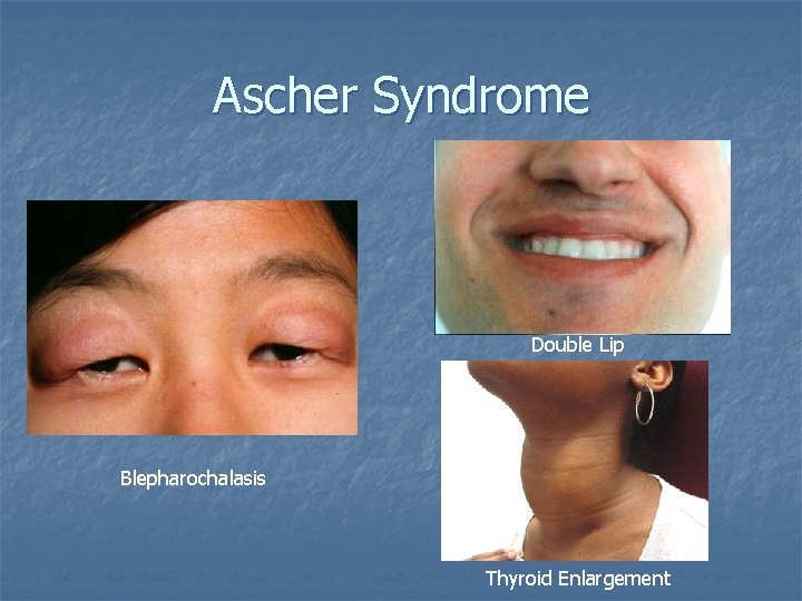 Ascher Syndrome Double Lip Blepharochalasis Thyroid Enlargement 