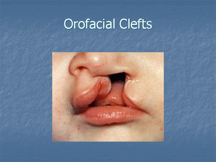 Orofacial Clefts 