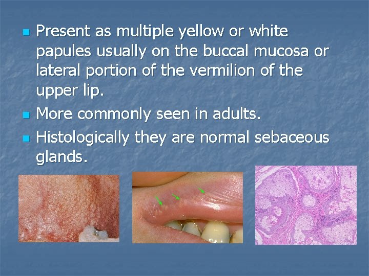 n n n Present as multiple yellow or white papules usually on the buccal