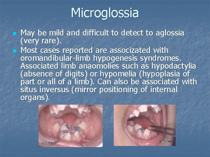 Microglossia n n May be mild and difficult to detect to aglossia (very rare).