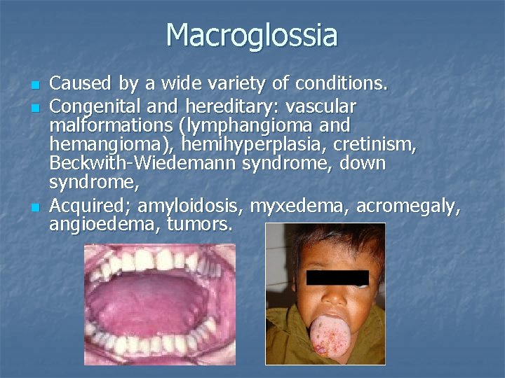 Macroglossia n n n Caused by a wide variety of conditions. Congenital and hereditary: