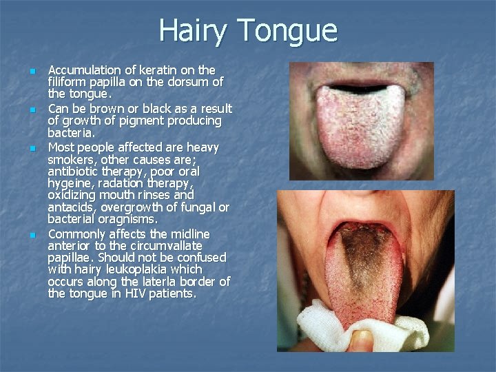 Hairy Tongue n n Accumulation of keratin on the filiform papilla on the dorsum