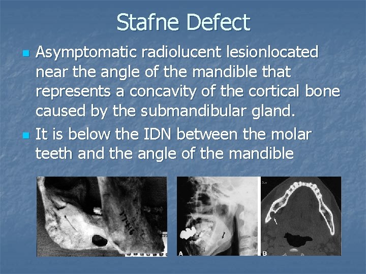 Stafne Defect n n Asymptomatic radiolucent lesionlocated near the angle of the mandible that