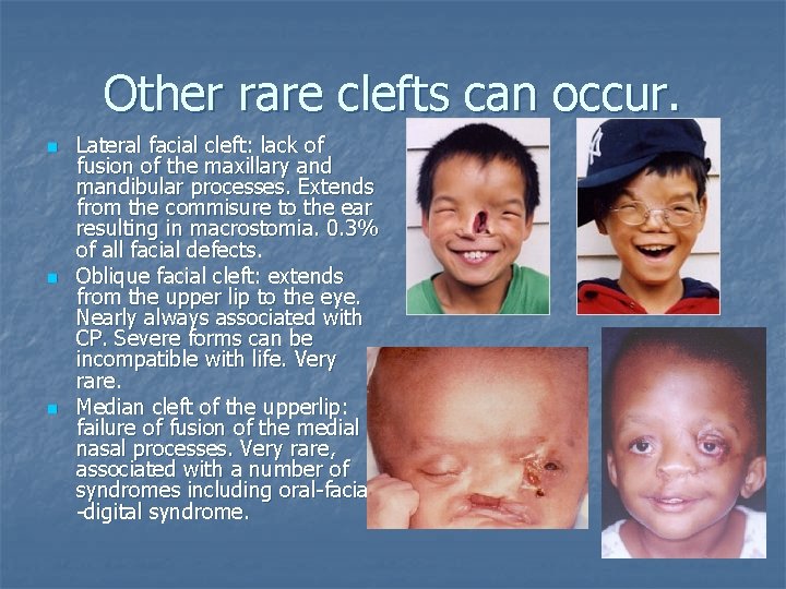 Other rare clefts can occur. n n n Lateral facial cleft: lack of fusion