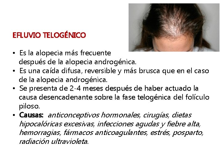 EFLUVIO TELOGÉNICO • Es la alopecia más frecuente después de la alopecia androgénica. •