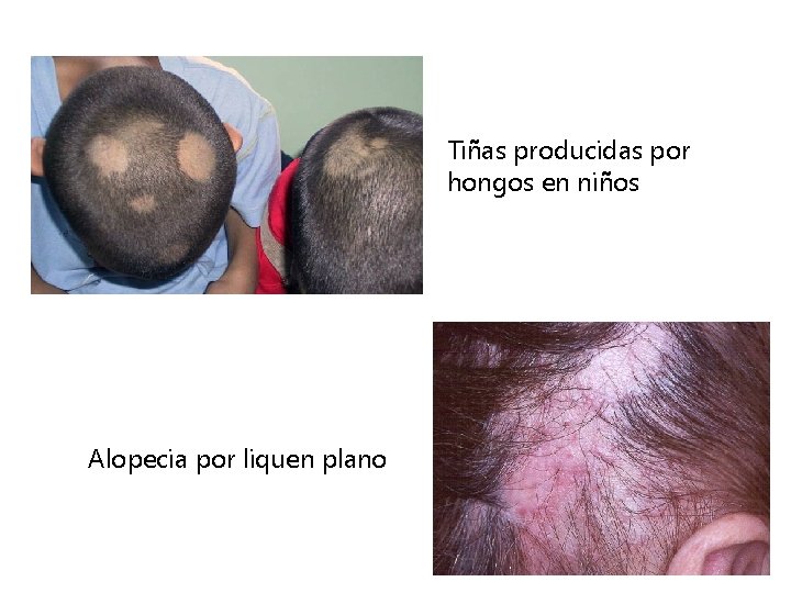 Tiñas producidas por hongos en niños Alopecia por liquen plano 