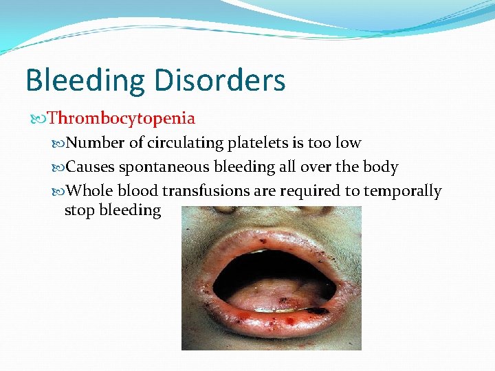 Bleeding Disorders Thrombocytopenia Number of circulating platelets is too low Causes spontaneous bleeding all