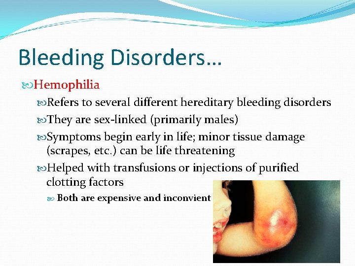 Bleeding Disorders… Hemophilia Refers to several different hereditary bleeding disorders They are sex-linked (primarily
