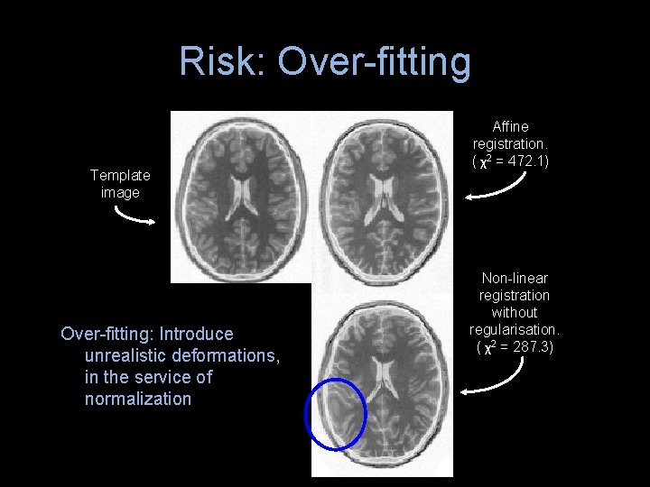 Risk: Over-fitting Template image Over-fitting: Introduce unrealistic deformations, in the service of normalization Affine Risk: Over-fitting Template image Over-fitting: Introduce unrealistic deformations, in the service of normalization Affine