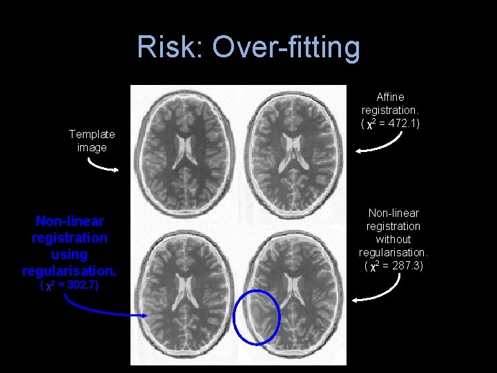 Risk: Over-fitting Template image Non-linear registration using regularisation. ( χ2 = 302. 7) Affine Risk: Over-fitting Template image Non-linear registration using regularisation. ( χ2 = 302. 7) Affine