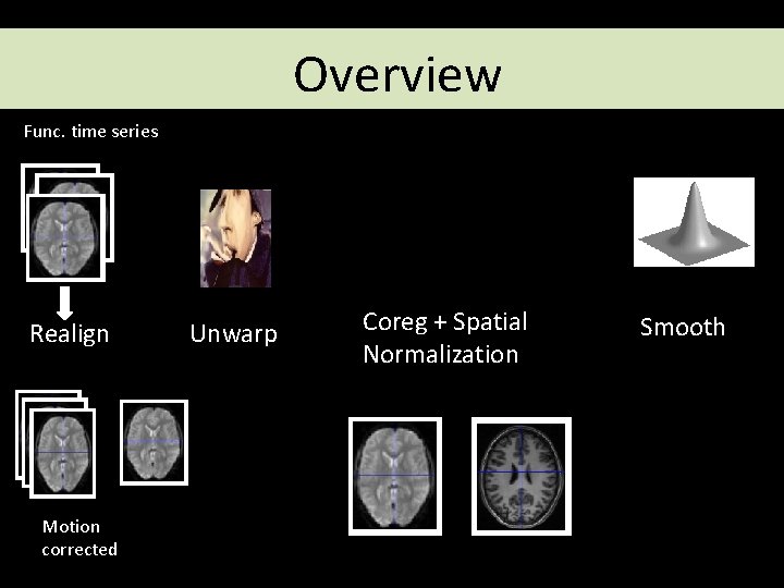 Overview Func. time series Realign Motion corrected Unwarp Coreg + Spatial Normalization Smooth Overview Func. time series Realign Motion corrected Unwarp Coreg + Spatial Normalization Smooth