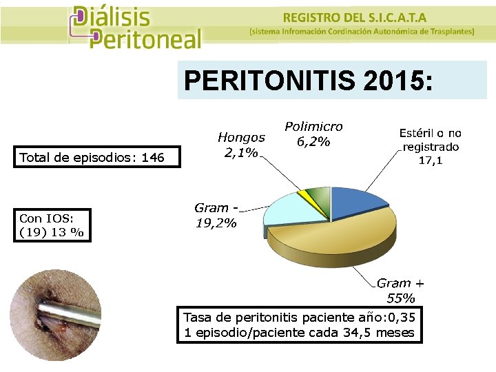 PERITONITIS 2015: Total de episodios: 146 Con IOS: (19) 13 % Tasa de peritonitis