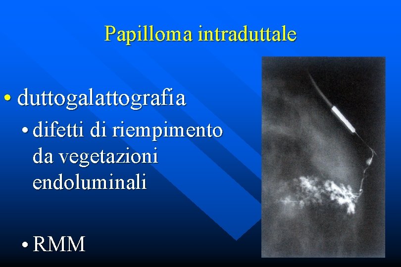 Papilloma intraduttale • duttogalattografia • difetti di riempimento da vegetazioni endoluminali • RMM 