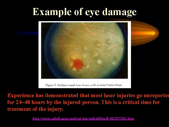 Example of eye damage Experience has demonstrated that most laser injuries go unreported for