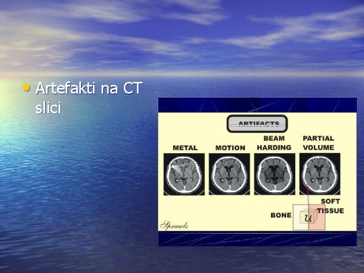  • Artefakti na CT slici 