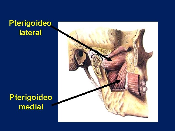 Pterigoideo lateral Pterigoideo medial 