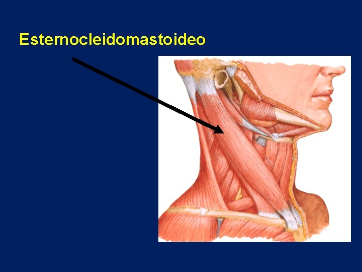 Esternocleidomastoideo 