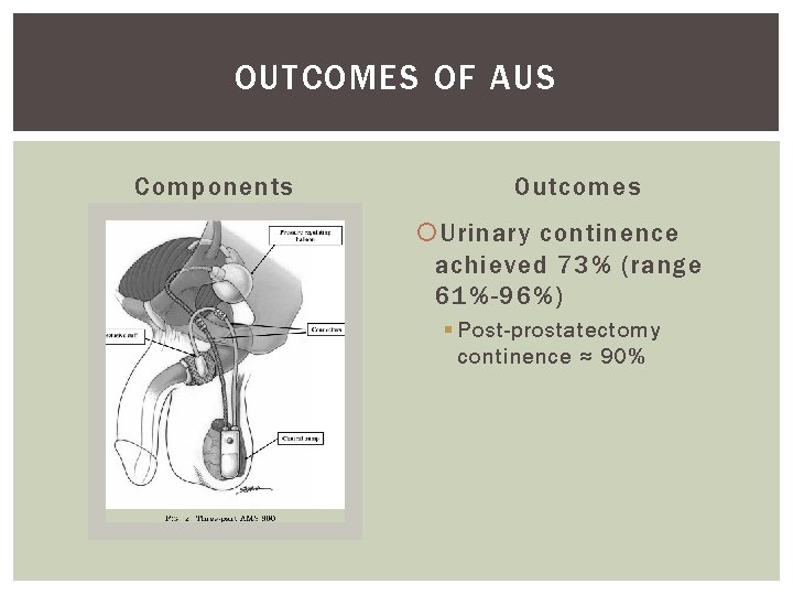OUTCOMES OF AUS Components Outcomes Urinary continence achieved 73% (range 61%-96%) § Post-prostatectomy continence OUTCOMES OF AUS Components Outcomes Urinary continence achieved 73% (range 61%-96%) § Post-prostatectomy continence