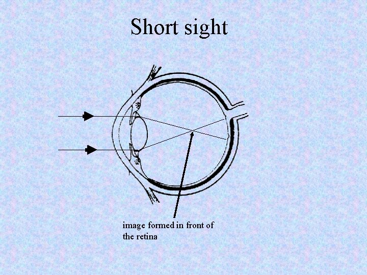 Short sight image formed in front of the retina 