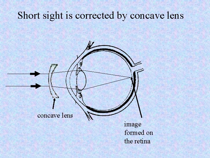 Short sight is corrected by concave lens image formed on the retina 