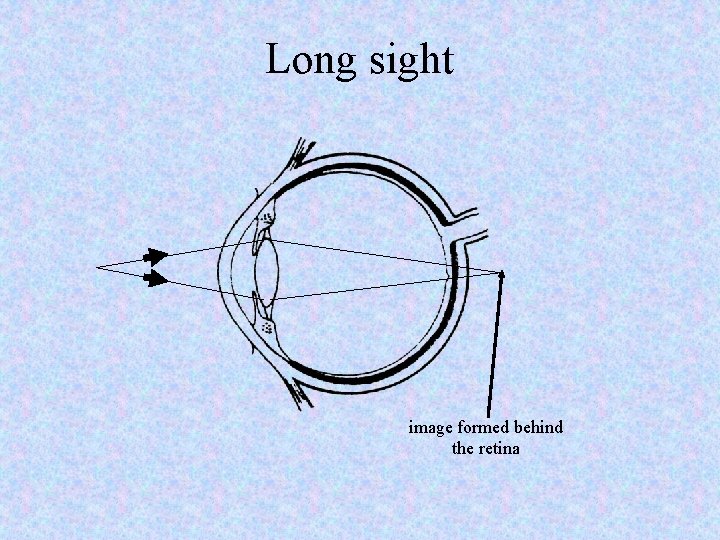 Long sight image formed behind the retina 