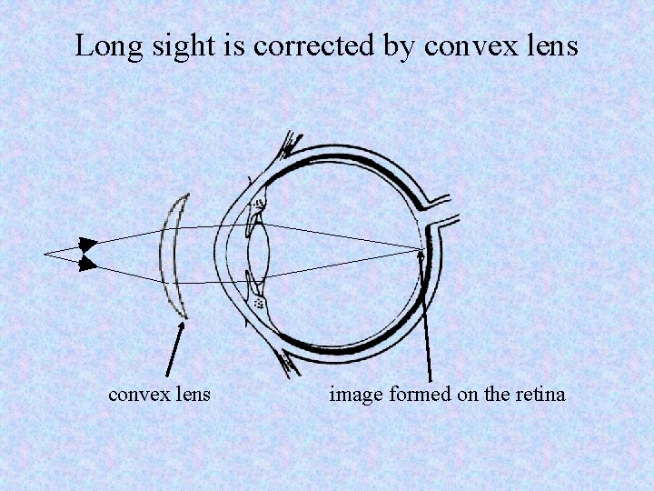 Long sight is corrected by convex lens image formed on the retina 