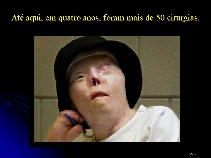 Até aqui, em quatro anos, foram mais de 50 cirurgias. >>> 