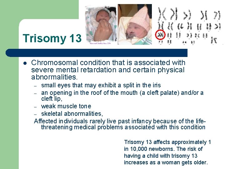 Trisomy 13 l Chromosomal condition that is associated with severe mental retardation and certain