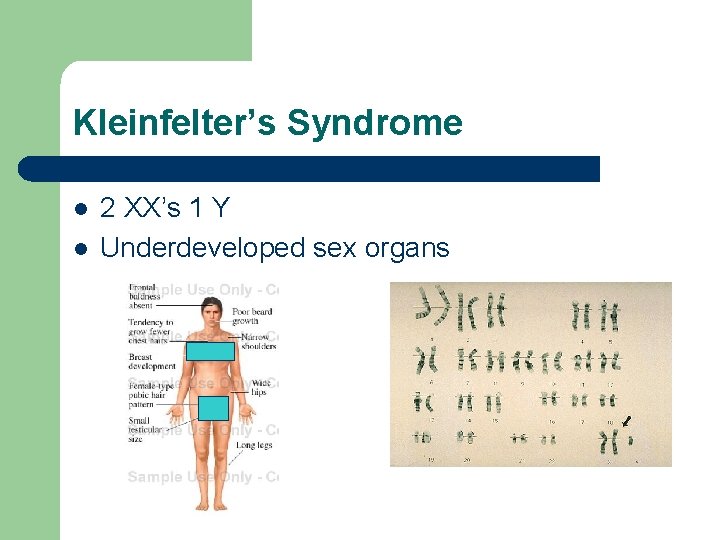 Kleinfelter’s Syndrome l l 2 XX’s 1 Y Underdeveloped sex organs 