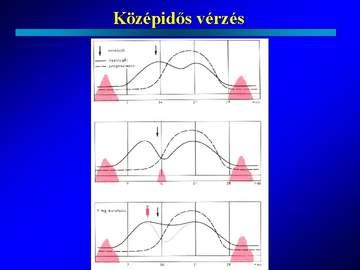 Középidős vérzés 