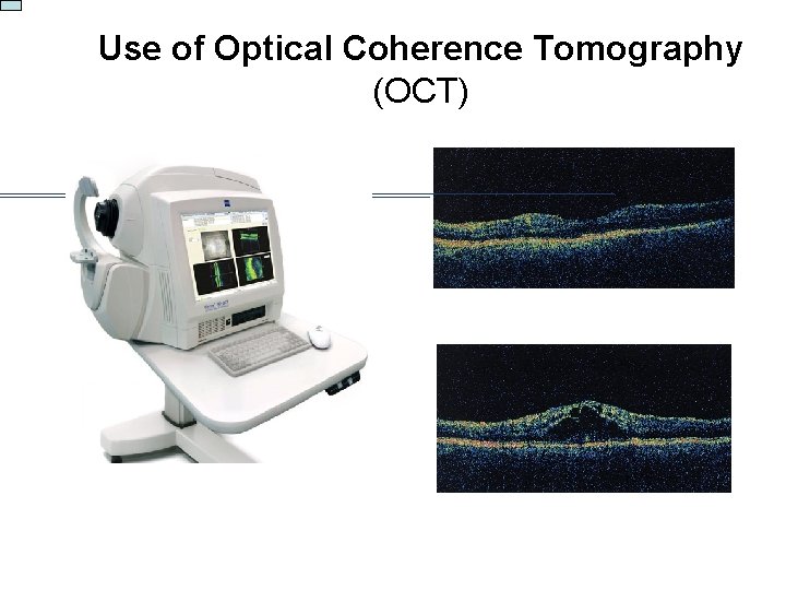 Use of Optical Coherence Tomography (OCT) 