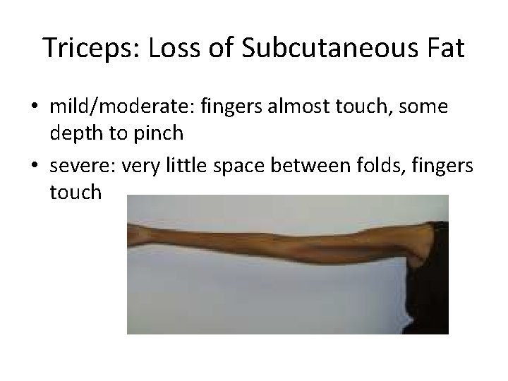 Triceps: Loss of Subcutaneous Fat • mild/moderate: fingers almost touch, some depth to pinch